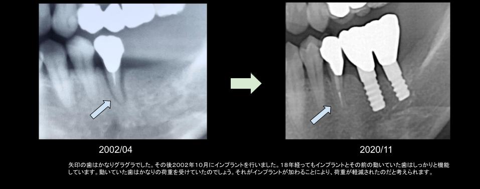 インプラントの１８年後